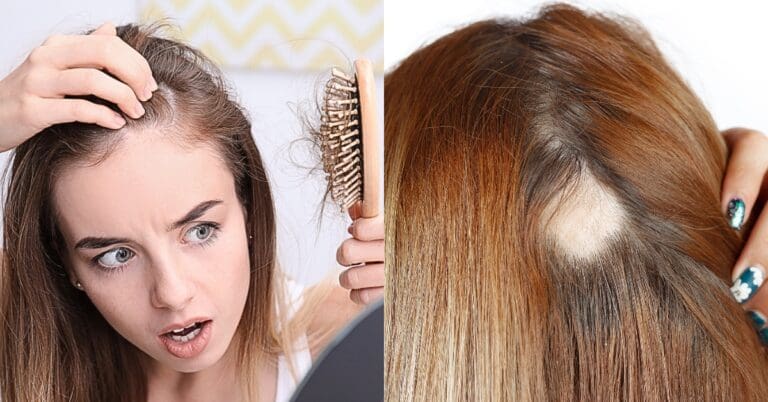 Saiba tudo sobre a alopecia feminina e como tratar 4 Saiba tudo sobre a alopecia feminina e como tratar